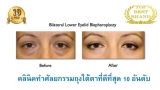 คุณมีถุงใต้ตาหรือไม่? 10 คลินิกผ่าตัดถุงใต้ตาที่ลูกค้าต่างไว้วางใจ 2026